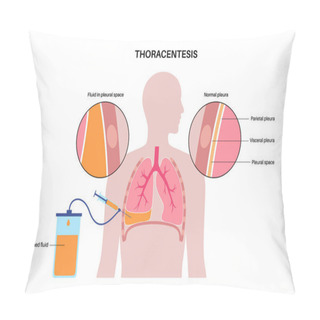 Personality  Thoracentesis Procedure Medical Poster. Obtain Fluid From Space Around The Compressed Lung. Incision Of The Chest Wall. Unhealthy Internal Organs, Respiratory System Disease Flat Vector Illustration Pillow Covers