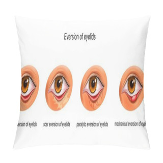 Personality  The Causes Of Eversion Of Eyelids Pillow Covers