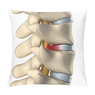Personality  Spinal Cord Under Pressure Of Bulging Disc Pillow Covers