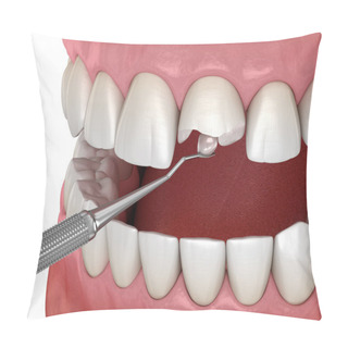 Personality  Restoration Of Broken Tooth. Medically Accurate 3D Illustration. Pillow Covers