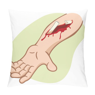 Personality  Illustration Of A Human Arm With A Compound Fracture Showing The Broken Bone. Ideal For Catalogs, Newsletters And First Aid Guides Pillow Covers