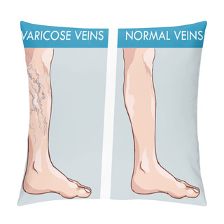 Personality  Illustration Of A Healthy Leg And The Affected Varicose Veins Pillow Covers