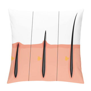 Personality  Normal And Ingrown Hair Vector Illustration Pillow Covers