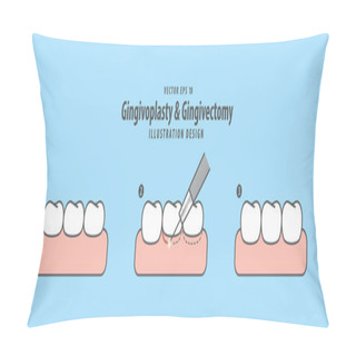 Personality  Gingivoplasty & Gingivectomy Step Electrosurgery Cut Gum Off Ill Pillow Covers