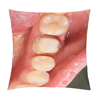 Personality  Molar Prepared For Dental Crown Pillow Covers