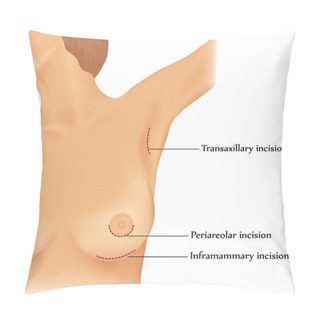Personality  Plastic Surgery Of Breast Implants Pillow Covers