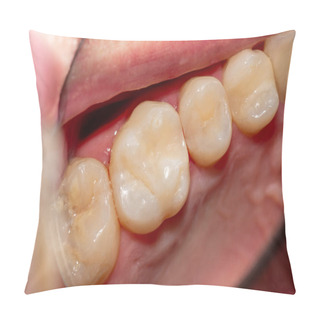 Personality  Treatment Tooth Decay With Subsequent Filling With Photopolymer Material. Close-up, Macro Pillow Covers