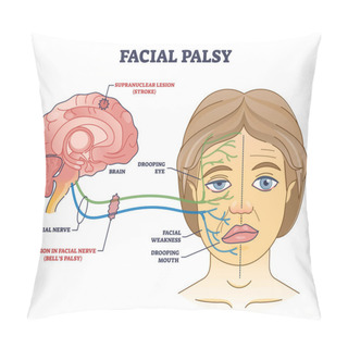 Personality  Facial Palsy And Muscles Weakness Because Of Nerve Damage Outline Diagram. Labeled Educational Scheme With Anatomical Brain Supranuclear Stroke Caused Dropping Mouth And Eye Vector Illustration. Pillow Covers