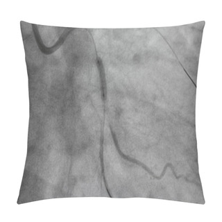 Personality  Coronary Angiography, Coronary Artery Disease. Medical X-ray Of Heart Disease. Healthcare And Medical Concept. Pillow Covers