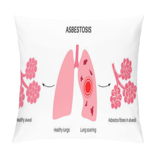 Personality  Asbestosis Anatomical Poster. Lung Disease Concept, Asbestos Fibers. Lung Tissue Scarring And Shortness Of Breath, Pain In Chest. Breathing Problem, Illness Of Respiratory System Vector Illustration. Pillow Covers