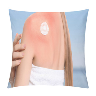 Personality  Woman With Sunburn Near Sea, Closeup. Skin Protection From Sun In Summer Pillow Covers
