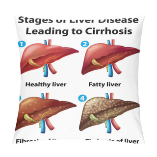Personality  Stages Of Liver Disease Leading To Cirrhosis Illustration Pillow Covers