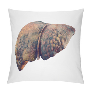 Personality  Realistic Illustration Of Cirrhosis Of Human Liver Pillow Covers