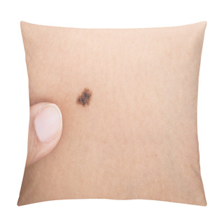 Personality  Birthmark On Human Skin Pillow Covers