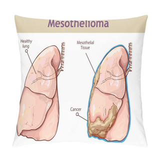 Personality   Vector Illustration Of A Pleural Mesothelioma. Pillow Covers