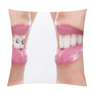 Personality  Teeth With Braces Pillow Covers