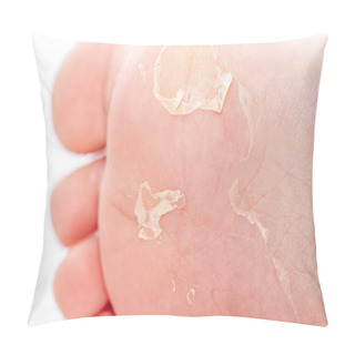 Personality  After The Red Rash And The Strawberry Tongue Caused By Scarlet Fever The Affected Skin Often Peels - Here Skin Of Foot Peeling Pillow Covers