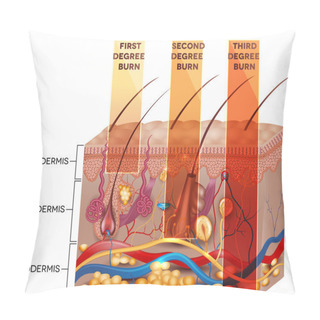 Personality  Skin Burn Classification Pillow Covers