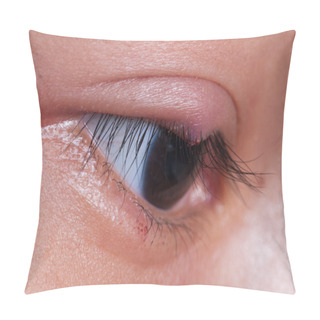 Personality  Close Up Right Upper Eye Lid Abscess, Stye Or Hordeolum Pillow Covers