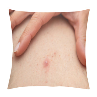 Personality  Folliculitis On Female Leg - Squeezing Pillow Covers