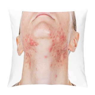 Personality  Young Girl With Skin Problem Pillow Covers
