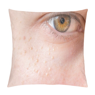 Personality  Milia (Milium) - Pimples Around Eye On Skin. Pillow Covers