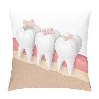 Personality  3d Render Of Teeth With Dental Inlay Filling Pillow Covers