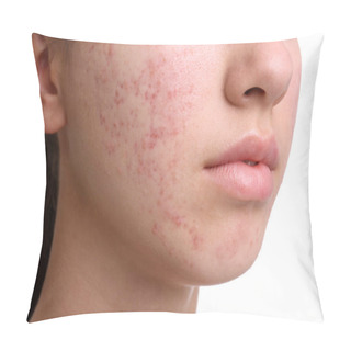 Personality  Teenage Girl With Acne Problem On White Background, Closeup Pillow Covers