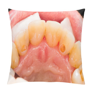 Personality  Dental Pulp Treatment Pillow Covers
