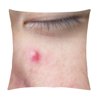 Personality  The Infected Pustulous Acne On Face, Selective Focus On Acne Pillow Covers