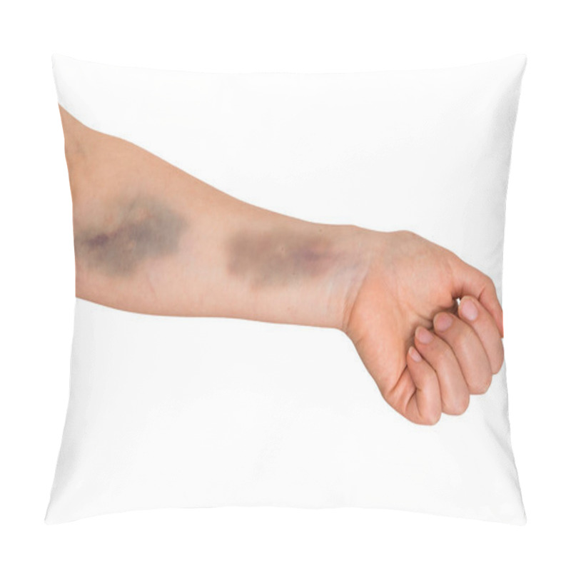 Personality  Large Bruise On Human Arm Pillow Covers
