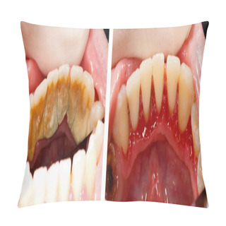 Personality  Massive Tartar And Treatment Pillow Covers
