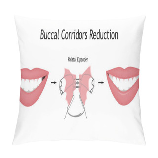 Personality  The Smile With Large And Dark Buccal Corridor Before And After The Orthotropics Or Orthotropics Correction. Vector Illustration. Pillow Covers