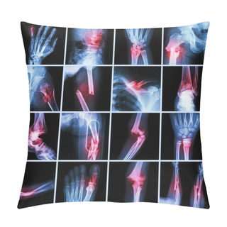 Personality  Collection X-ray Multiple Bone Fracture (finger,spine,wrist,hip,leg,clavicle,ankle,elbow,arm,foot) Pillow Covers