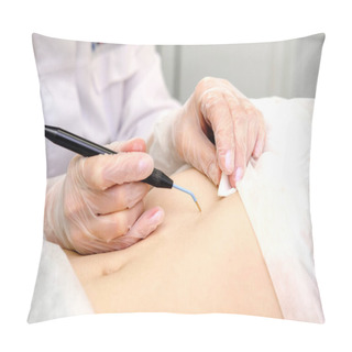 Personality  Medical Treatment Removal Of Birthmark From Female Patient's Stomach. Female Dermatologist Surgeon Using Electrocautery For Removing Mole On Belly. Radio Wave Electrocoagulation Remove Method Pillow Covers