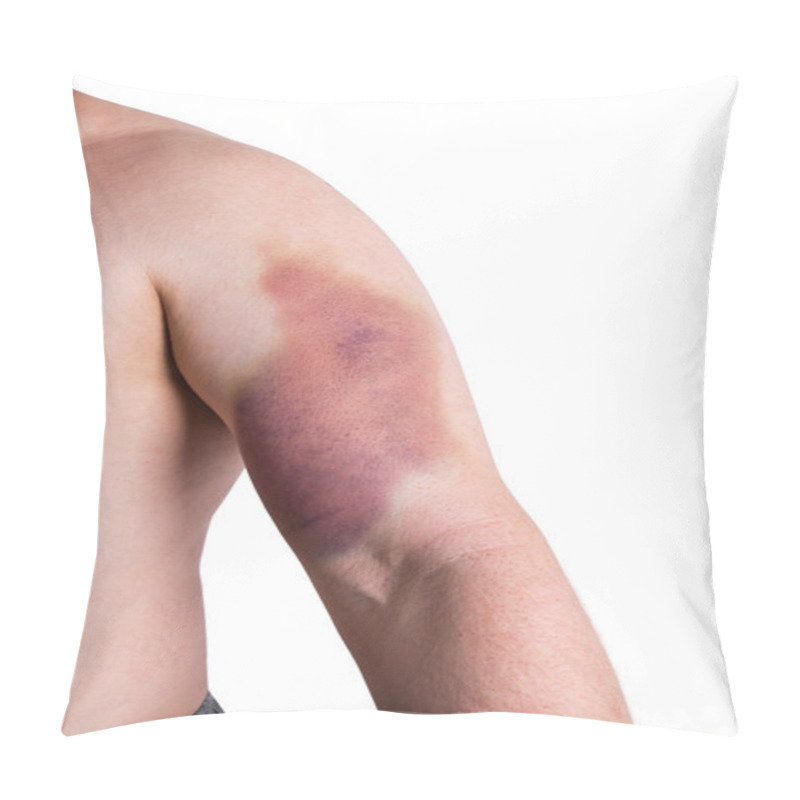 Personality  Large Bruise On Man's Arm Pillow Covers