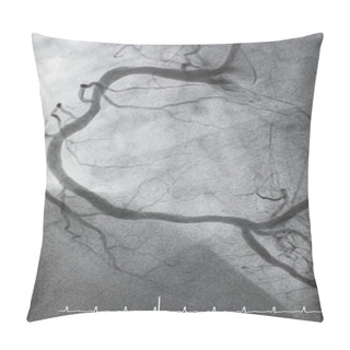 Personality  Coronary Angiography , Right Coronary Angiography Pillow Covers