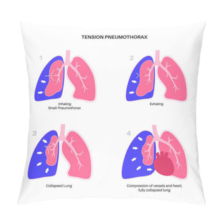 Personality  Tension Pneumothorax Disease. Reducing The Amount Of Blood Returned To The Heart. Lung Or Chest Wall Injury. Chest Pain, Shortness Of Breathing. Unhealthy Internal Organs In Respiratory System Vector Pillow Covers