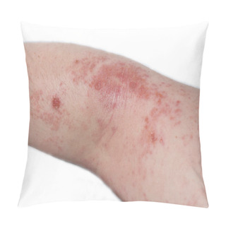 Personality  Red, Itchy Eczema Rash On The Elbow Of A Teenage Boy. Pillow Covers