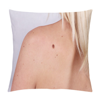 Personality  Young Woman With At Birthmark On Her Back, Skin. Checking Benign Moles Pillow Covers