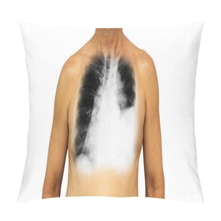 Personality  Lung Cancer . Human Chest And X-ray Show Pleural Effusion Left Lung Due To Lung Cancer Pillow Covers