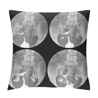 Personality  Hysterosalpingography Radiology The Uterus Is Normal Size And Shape.Both Tubes Appear Normal,Good Spillage Of Contrast To Peritoneal Cavity,bilaterally. Pillow Covers