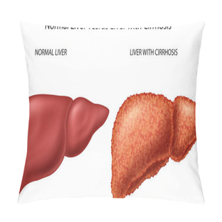 Personality  Normal Liver Versus Liver With Cirrhosis Pillow Covers
