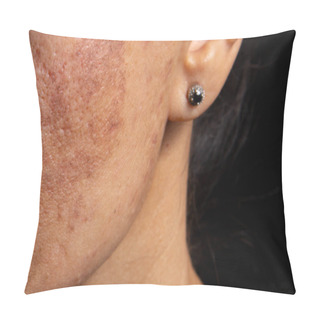 Personality  Age Spots And Increased Skin Pigmentation During Sunburn. The Rules Of Health Care In The Middle Age. Pillow Covers