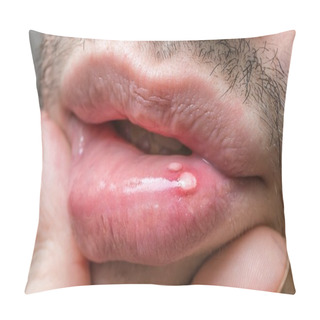 Personality  Painful Aphtha Ulcer On Man's Mouth. Pillow Covers