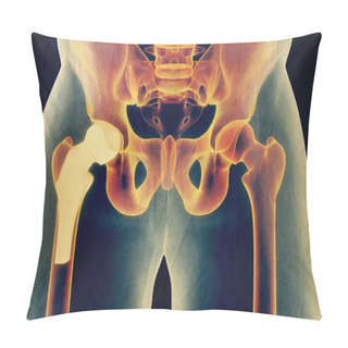 Personality  Hip Replacement Model Pillow Covers