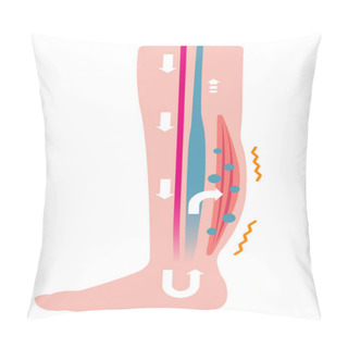 Personality  Cause Of Swelling(edema) Of The Legs. Water Leaks From The Veins And Swelling Occurs. Flat Illustration Pillow Covers