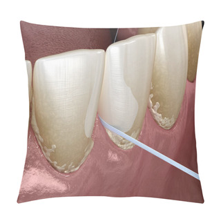 Personality  Oral Hygiene: Using Dental Floss For Plaque Removing. Medically Accurate Dental 3D Illustration Pillow Covers