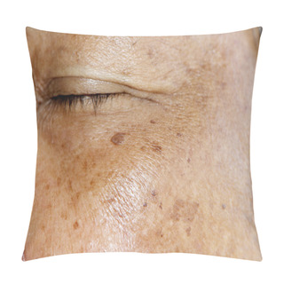 Personality  Melasma Or Sun Burn Pigmentations Pillow Covers