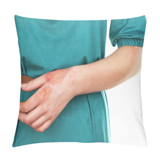Personality  Horrible Burns On Female Hand On White Background Pillow Covers